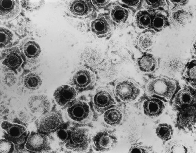 Virus del herpes simple.
