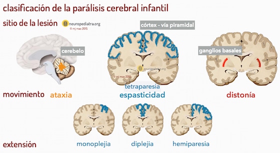 Tipos de parálisis cerebral